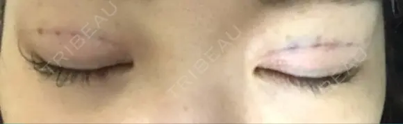 二重埋没 城本クリニック 大阪院 DAY 0 メイン用