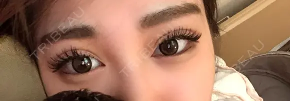 二重埋没 城本クリニック 大阪院 DAY 6 メイン用