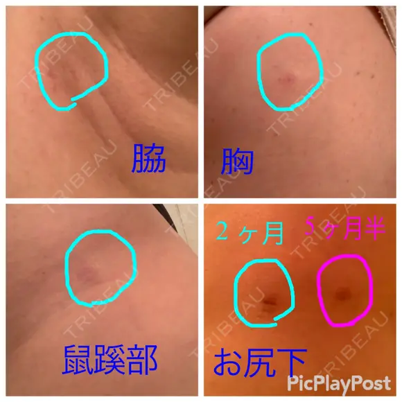 脂肪吸引（脚） / 豊胸（脂肪注入） 銀座3丁目・BANNAI美容クリニック DAY 60 メイン用