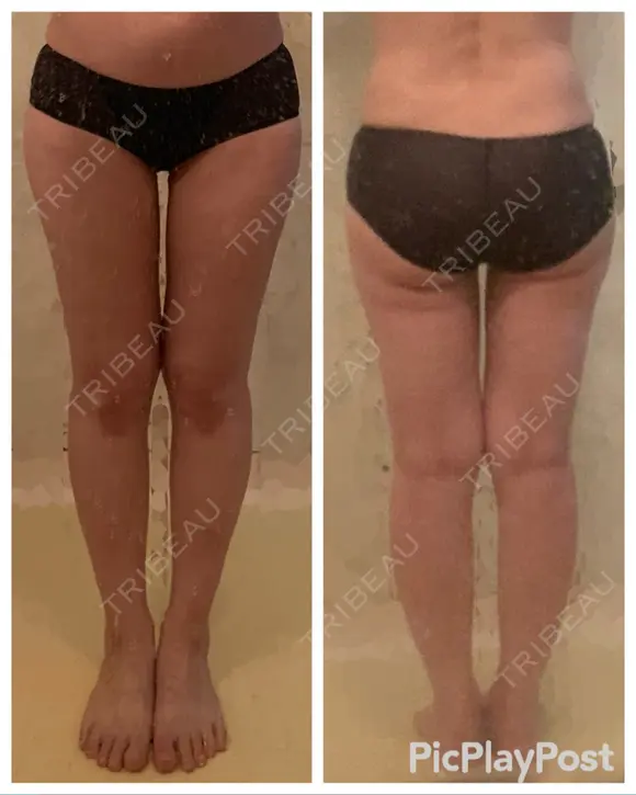 脂肪吸引（脚） / 豊胸（脂肪注入） 銀座3丁目・BANNAI美容クリニック DAY 60 メイン用
