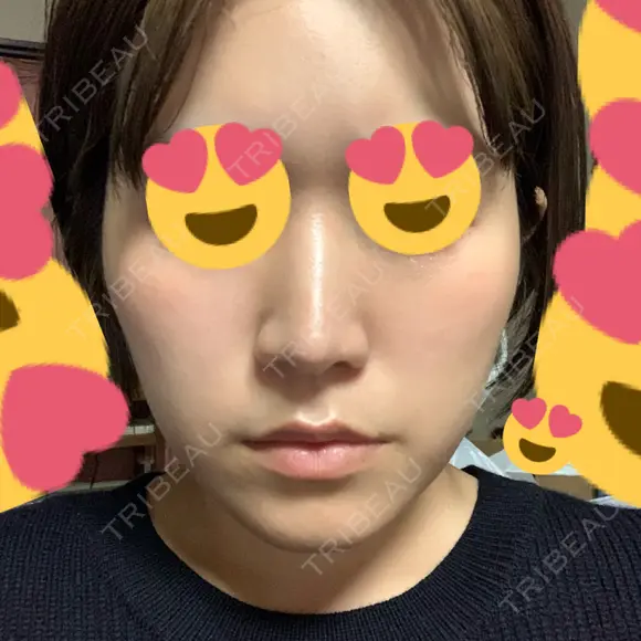 脂肪溶解注射（顔） 赤坂プレミアクリニック DAY 6 メイン用