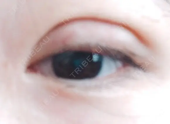 二重切開 / 目元修正 水の森美容クリニック 名古屋院 DAY 10 メイン用