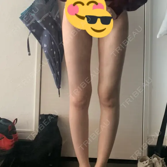 脂肪吸引（脚） / 豊胸（脂肪注入） / 脂肪注入（額） 湘南美容クリニック 新橋銀座口院 DAY 51 メイン用