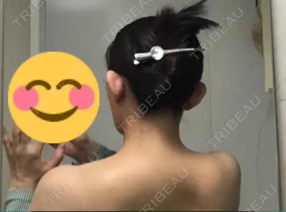 ボトックス（肩） 湘南美容クリニック 奈良院 DAY 17 メイン用