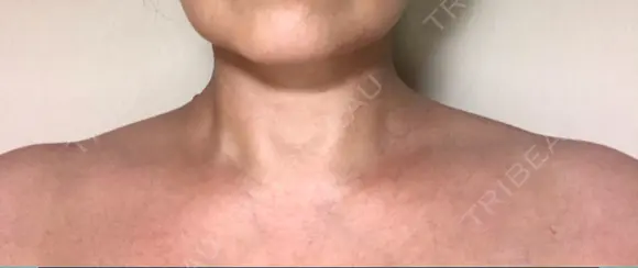 ボトックス（肩） 湘南美容クリニック 奈良院 DAY 17 メイン用