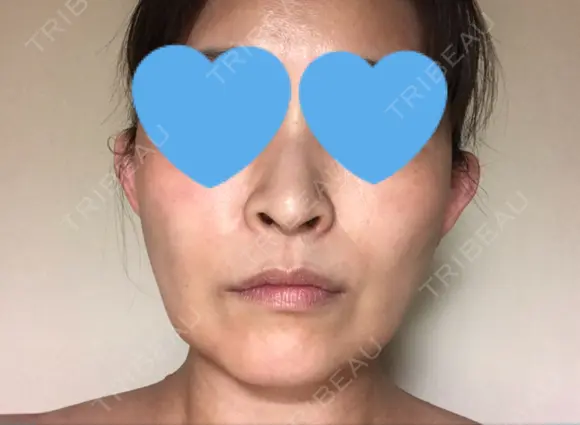 ハイフ（顔） / イオン導入 湘南美容クリニック 奈良院 DAY 17 メイン用