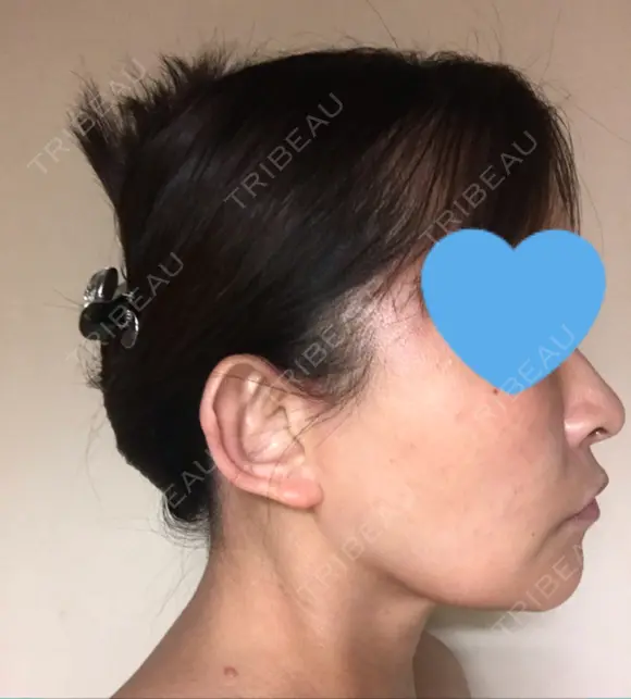 ハイフ（顔） / イオン導入 湘南美容クリニック 奈良院 DAY 17 メイン用