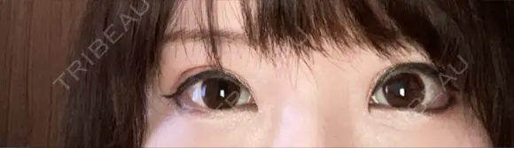 二重切開 / 眼瞼下垂（切開） / 上まぶたたるみ取り / 上まぶたの脂肪取り 湘南美容クリニック 船橋院 AFTER メイン用