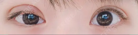 二重切開 / 目元修正 水の森美容クリニック 名古屋院 DAY 13 メイン用