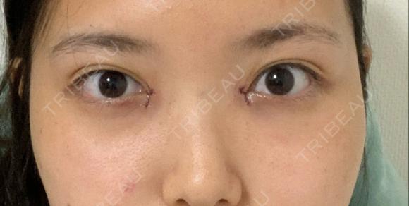 目頭切開 オジスキンクリニック DAY 0 メイン用
