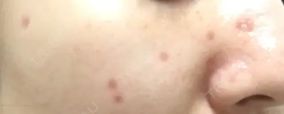 ほくろ・いぼ切除（肌） / ほくろ・いぼ除去レーザー（肌） 赤坂メディカルMクリニック DAY 29 メイン用