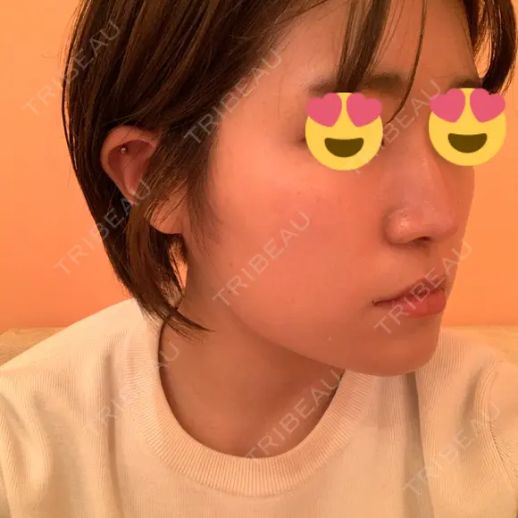 脂肪溶解注射（顔） 赤坂プレミアクリニック DAY 11 メイン用