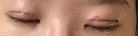 二重切開 郡山タウン形成外科クリニック DAY 5 メイン用