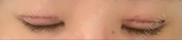 二重切開 郡山タウン形成外科クリニック DAY 6 メイン用