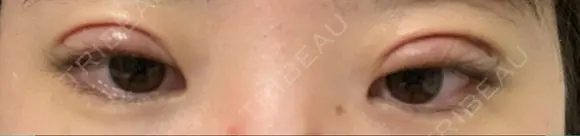 二重切開 郡山タウン形成外科クリニック DAY 6 メイン用