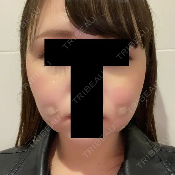 脂肪溶解注射（顔） 赤坂プレミアクリニック DAY 0 メイン用