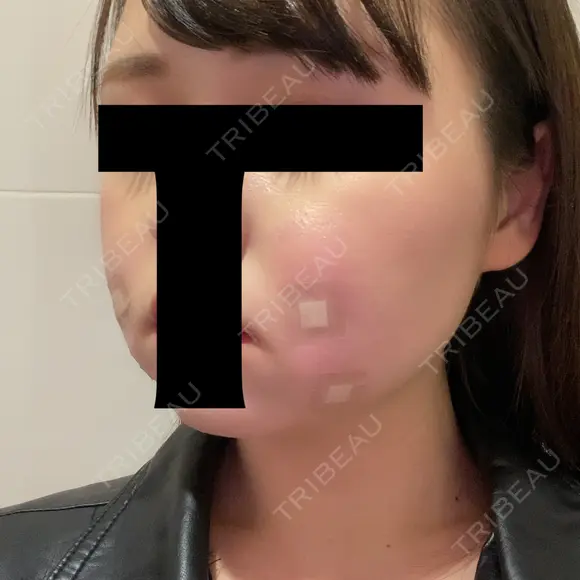 脂肪溶解注射（顔） 赤坂プレミアクリニック DAY 0 メイン用