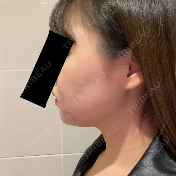 脂肪溶解注射（顔） 赤坂プレミアクリニック DAY 0 メイン用