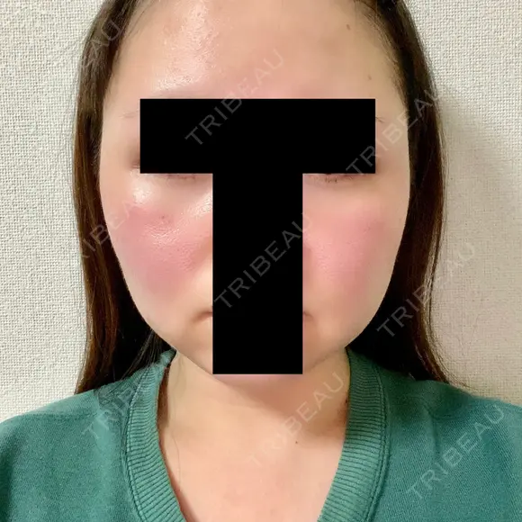 脂肪溶解注射（顔） 赤坂プレミアクリニック DAY 4 メイン用