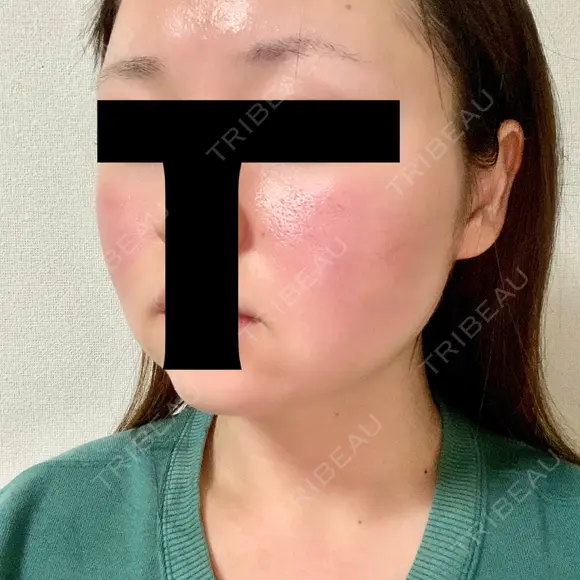 脂肪溶解注射（顔） 赤坂プレミアクリニック DAY 4 メイン用