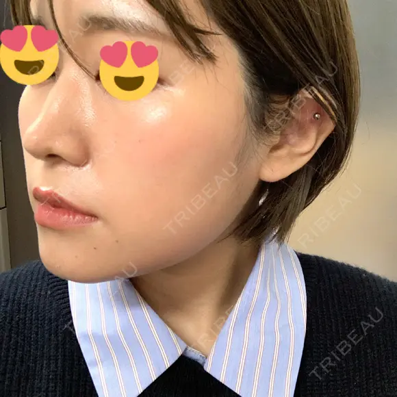 脂肪溶解注射（顔） 赤坂プレミアクリニック DAY 12 メイン用
