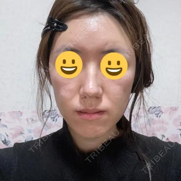 脂肪溶解注射（顔） / PRP皮膚再生療法 閉院｜プルージュ美容クリニック 赤羽院 DAY 4 メイン用