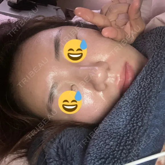 脂肪溶解注射（顔） / PRP皮膚再生療法 閉院｜プルージュ美容クリニック 赤羽院 DAY 5 メイン用