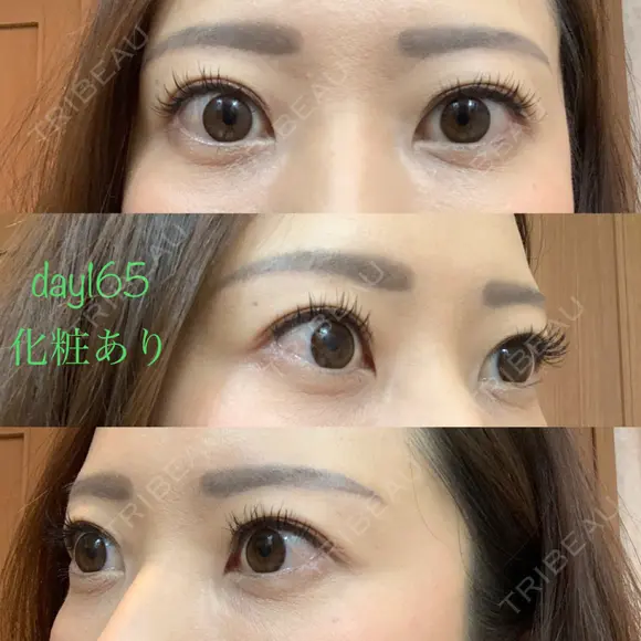 眉下切開 湘南美容クリニック 秋葉原院 DAY 165 メイン用