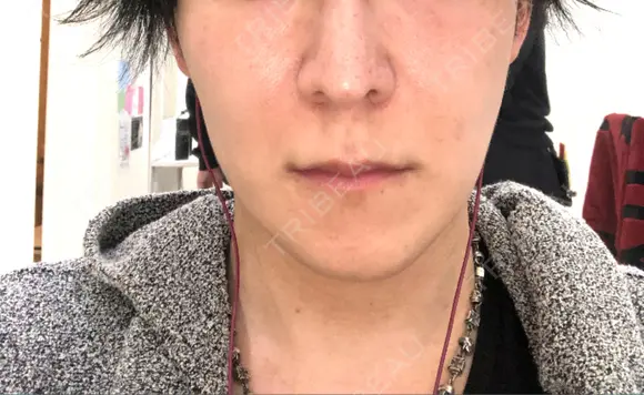 骨切り（あご） / 骨削り（エラ） 加藤クリニック 麻布東京院 DAY 98 メイン用