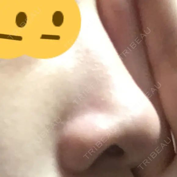 その他（鼻） 湘南美容クリニック 横須賀中央院 DAY 8 メイン用