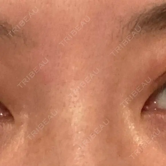 眼瞼下垂（切開） くさのたろうクリニック DAY 21 メイン用