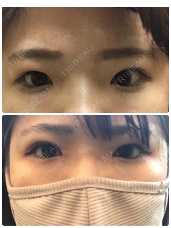 二重埋没 / 目頭切開 湘南美容クリニック 京都院 DAY 10 メイン用