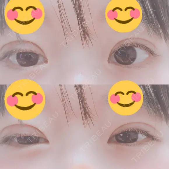 二重切開 / 目元修正 水の森美容クリニック 名古屋院 DAY 16 メイン用