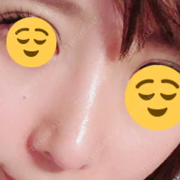 鼻尖形成（切開） / 鼻中隔延長（切開） / 軟骨移植 / 鼻翼基部形成（貴族手術） HANABI整形外科 DAY 44 メイン用