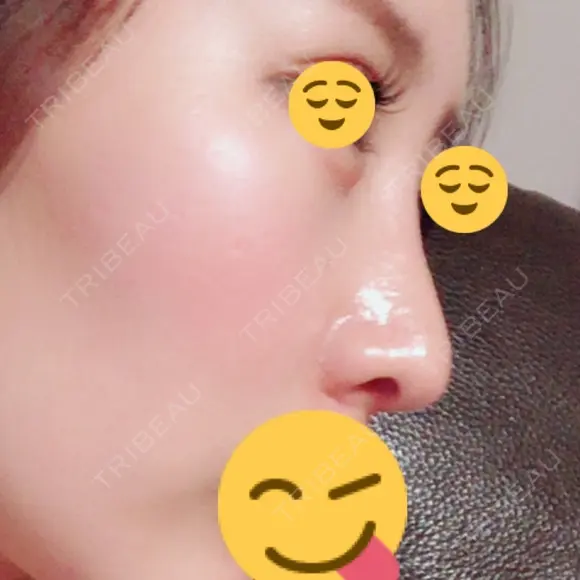 鼻尖形成（切開） / 鼻中隔延長（切開） / 軟骨移植 / 鼻翼基部形成（貴族手術） HANABI整形外科 DAY 44 メイン用