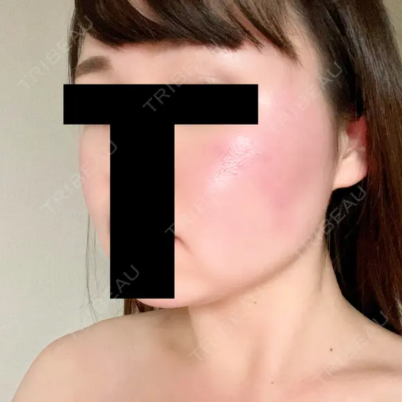 脂肪溶解注射（顔） 赤坂プレミアクリニック DAY 8 メイン用