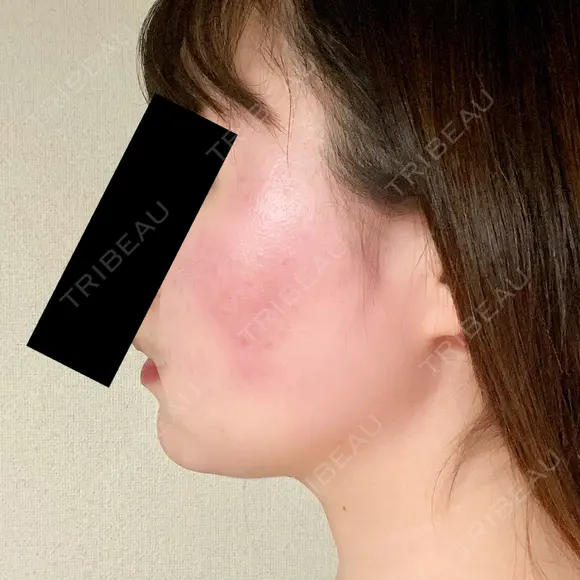 脂肪溶解注射（顔） 赤坂プレミアクリニック DAY 8 メイン用