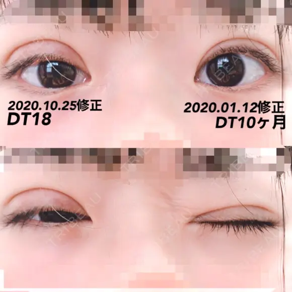二重切開 / 目元修正 水の森美容クリニック 名古屋院 DAY 18 メイン用