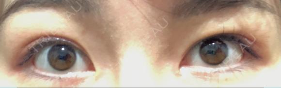 目頭切開 アロマ美容外科クリニック DAY 58 メイン用