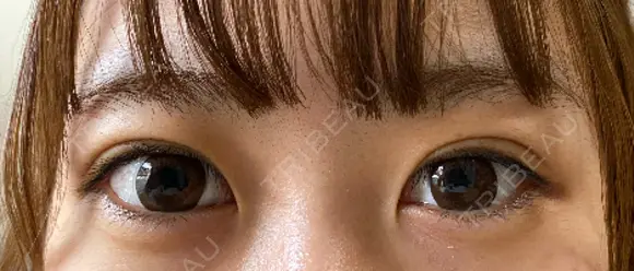 二重埋没 ながしまクリニック DAY 23 メイン用
