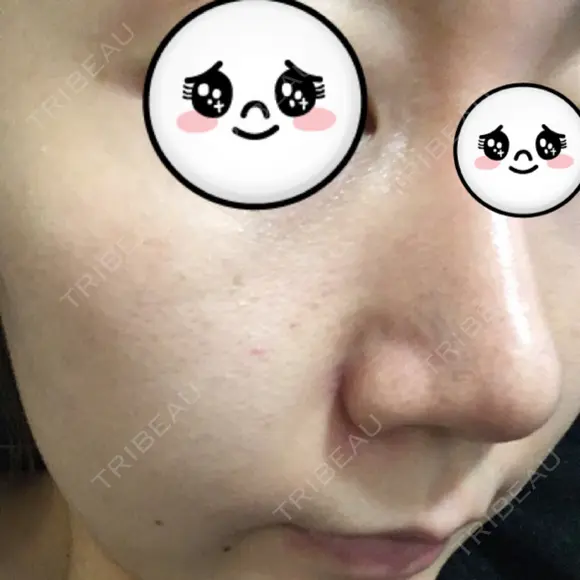 鼻尖形成（切開） / ヒアルロン酸注入（鼻） 東京ヒルズクリニック 新宿院 AFTER メイン用