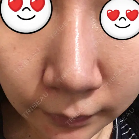 鼻尖形成（切開） / ヒアルロン酸注入（鼻） 東京ヒルズクリニック 新宿院 DAY 93 メイン用