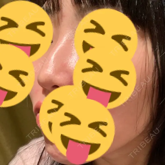 その他（鼻） 聖心美容クリニック 大阪院 DAY 14 メイン用