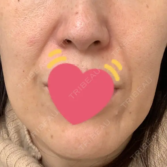 ボトックス（エラ・小顔） 湘南美容クリニック 藤沢院 DAY 0 メイン用