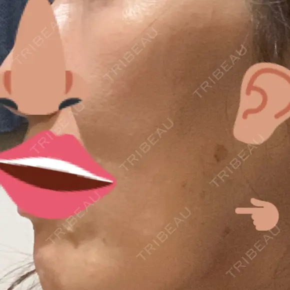 ボトックス（エラ・小顔） 湘南美容クリニック 藤沢院 DAY 0 メイン用