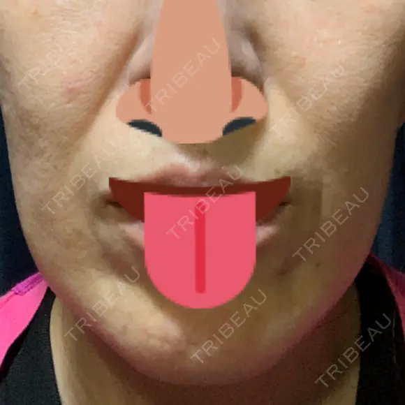 ボトックス（エラ・小顔） 湘南美容クリニック 藤沢院 DAY 3 メイン用