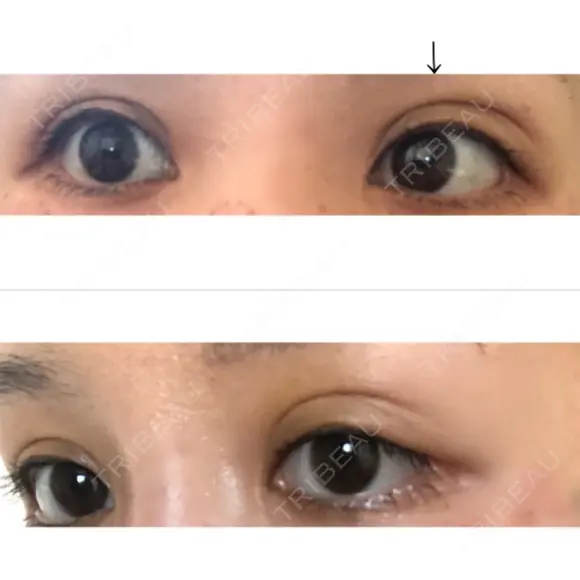 二重埋没 / 自然癒着法 表参道スキンクリニック 名古屋院（DAILY SKIN CLINIC提携院） AFTER メイン用