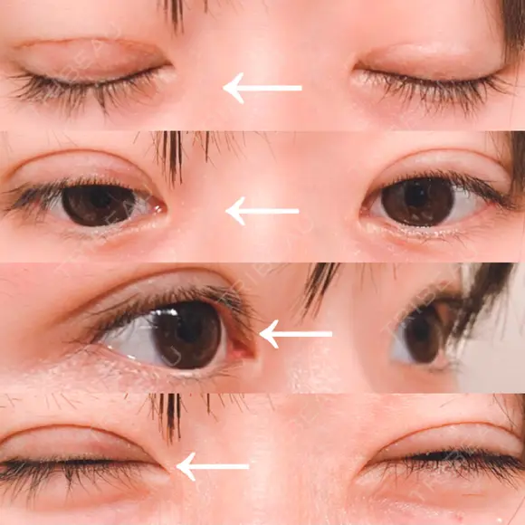 二重切開 / 目元修正 水の森美容クリニック 名古屋院 DAY 22 メイン用