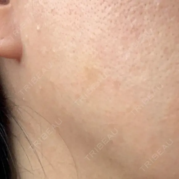 ボトックス（エラ・小顔） 湘南美容クリニック 藤沢院 DAY 6 メイン用