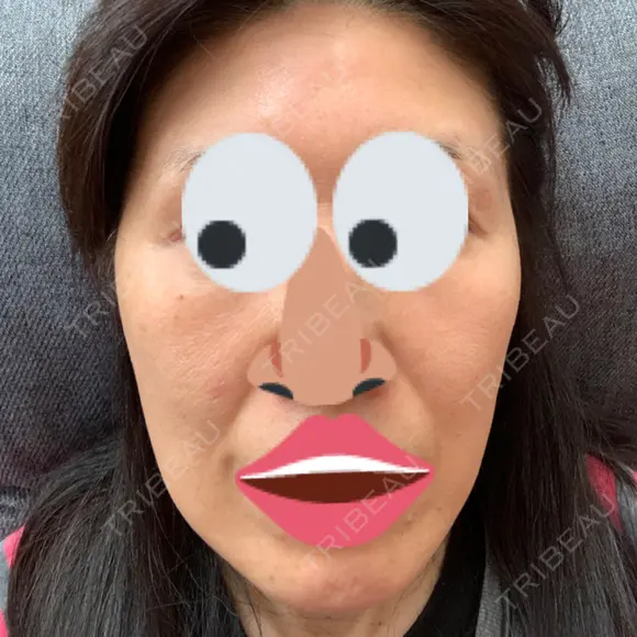 ボトックス（エラ・小顔） 湘南美容クリニック 藤沢院 DAY 6 メイン用